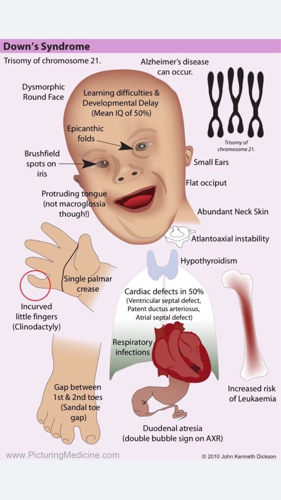 Down syndrome: Causes, characteristics, is it genetic, and more